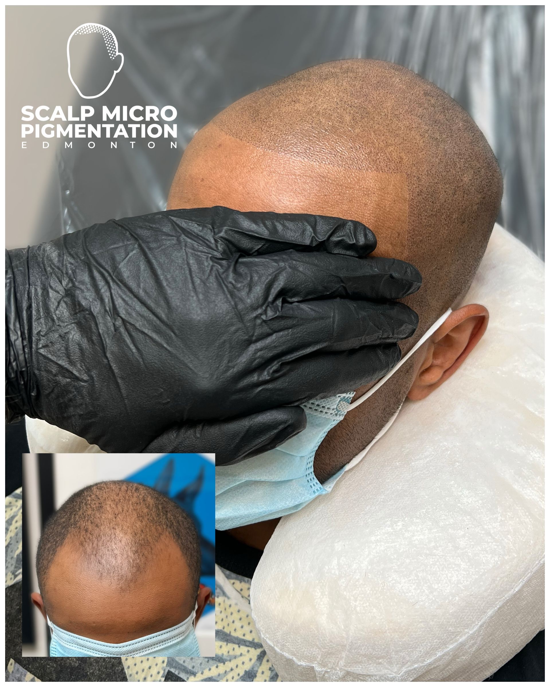 Before and After SMP Scalp micropigmentation