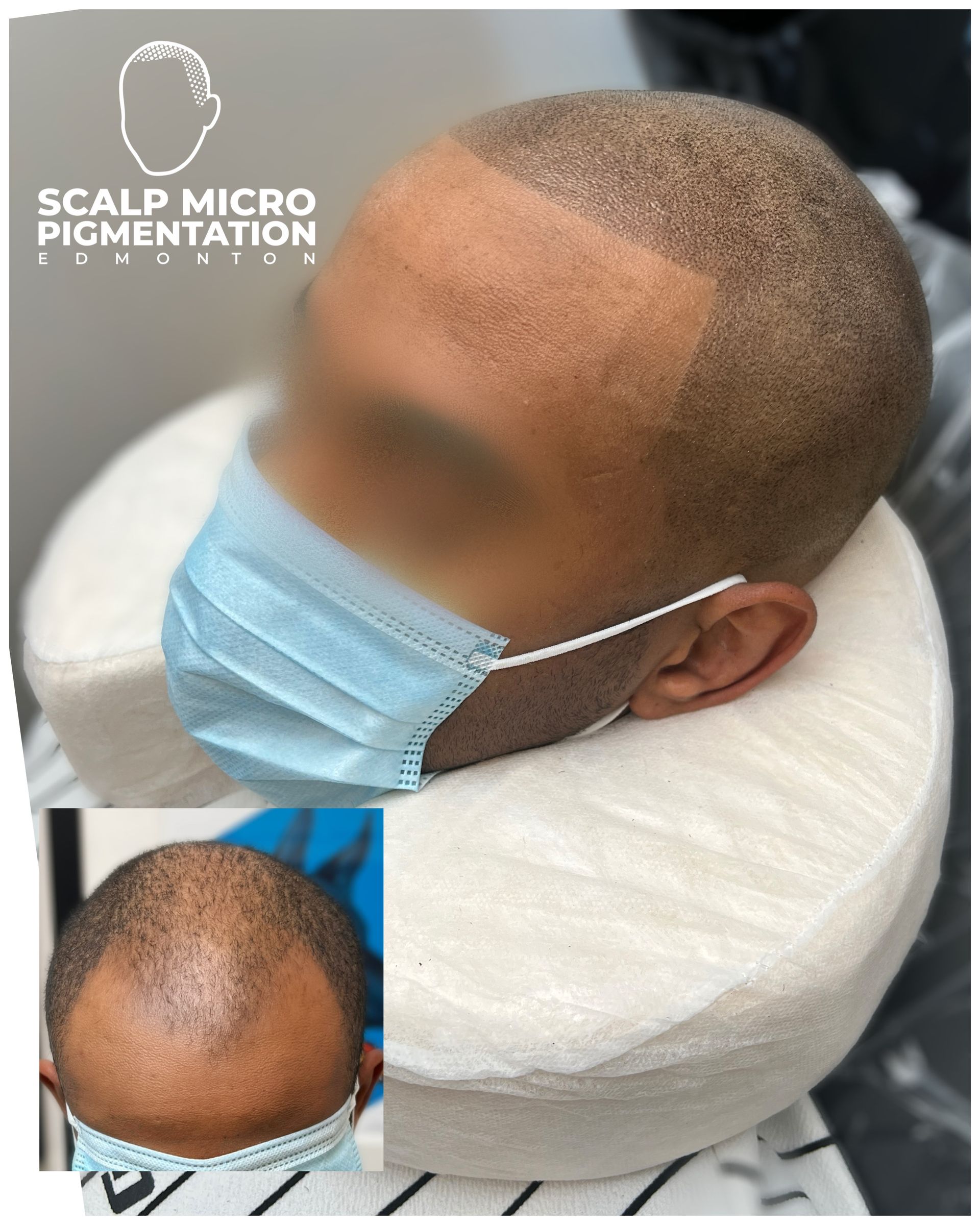 Before and After SMP Scalp micropigmentation