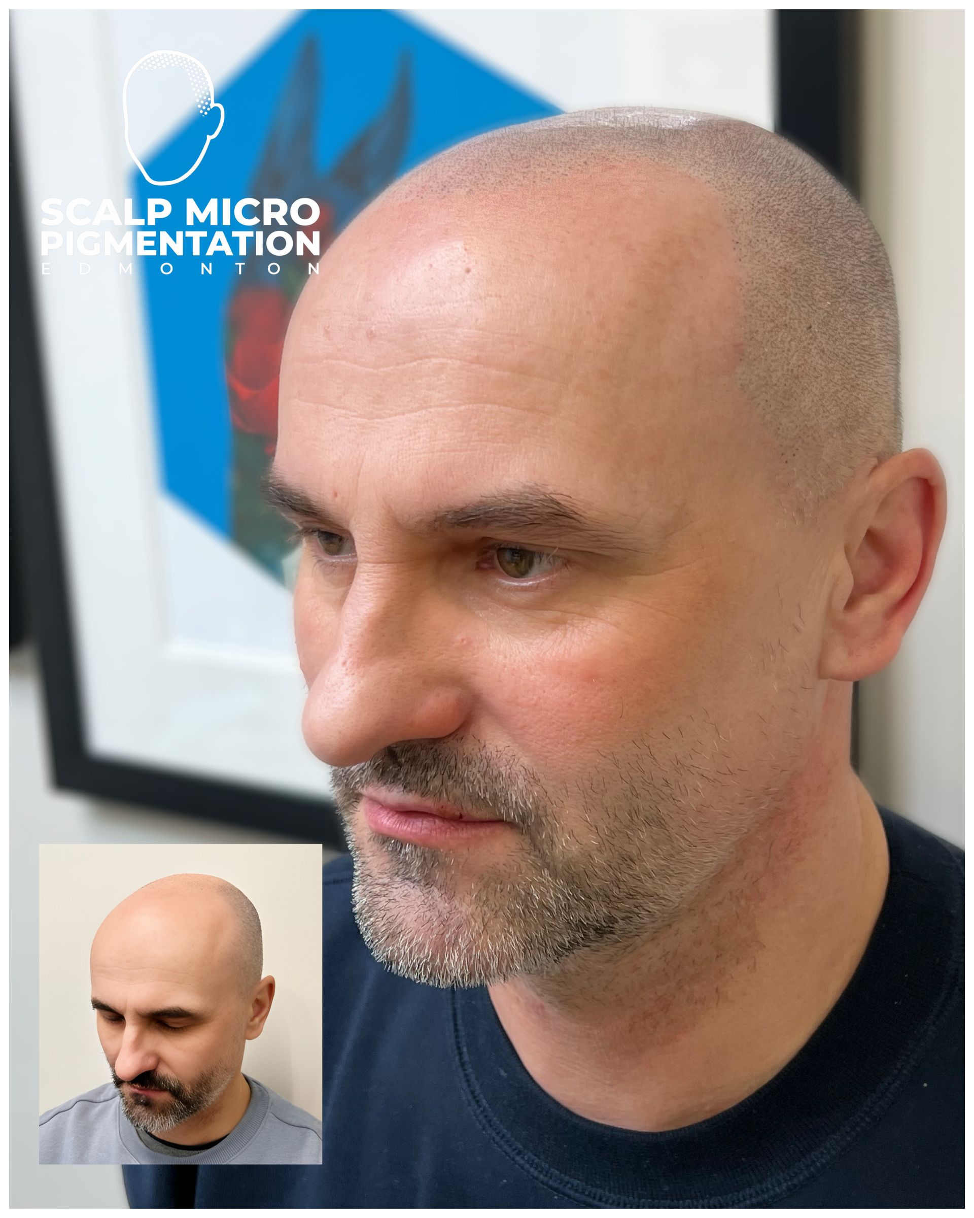 Before and After SMP Scalp micropigmentation