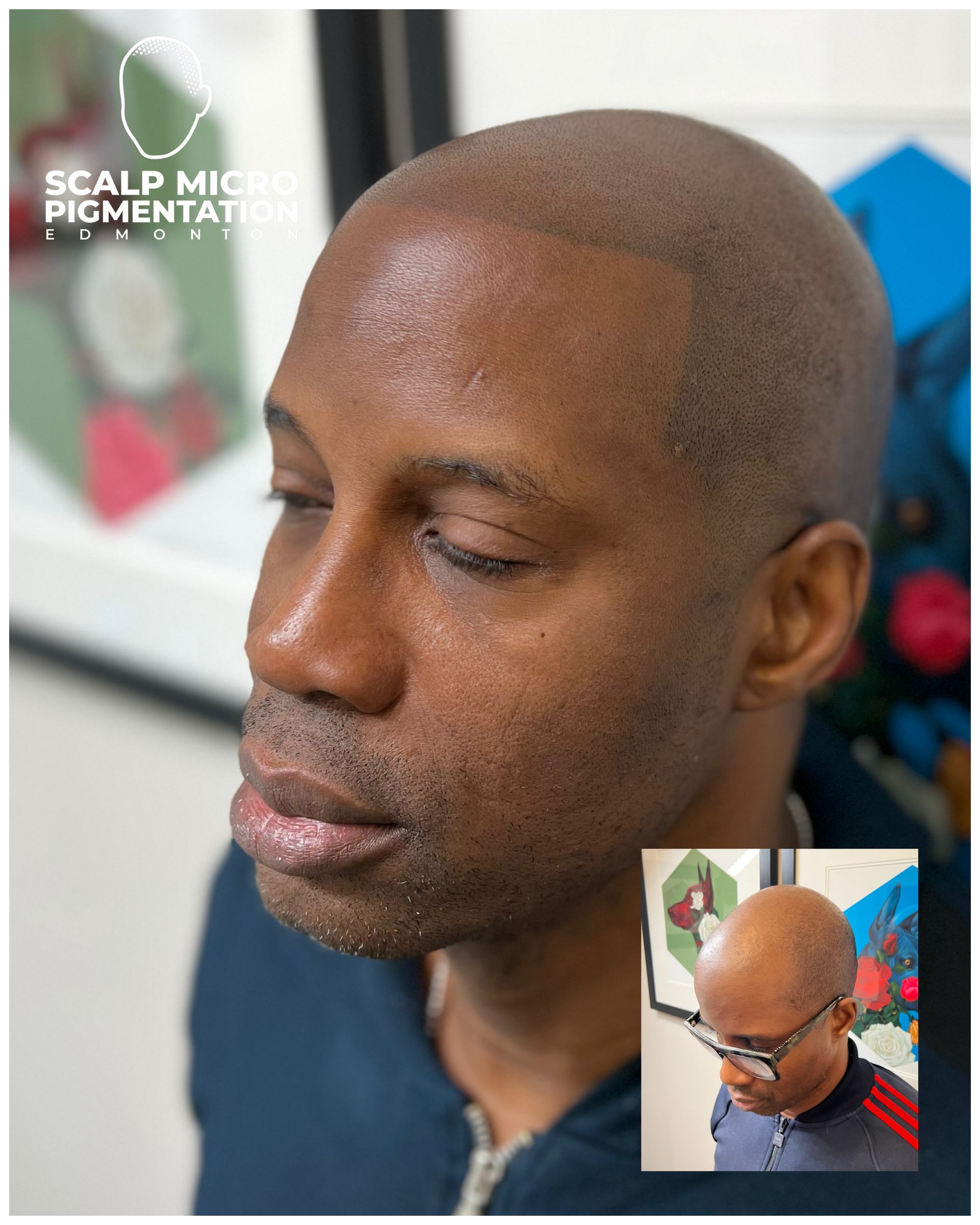 Before and After SMP Scalp micropigmentation