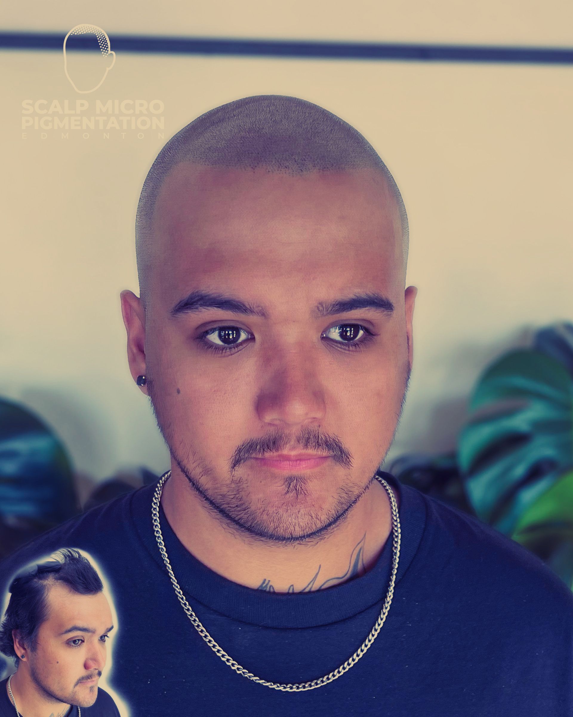 scalp-micro-pigmentation-edmonton-smp-hair-tattoo-bald-and-thinning
