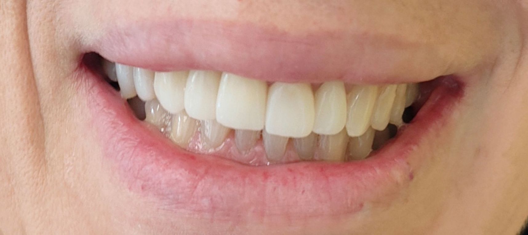 Prima e dopo 5 - Arte Dentale Frosinone