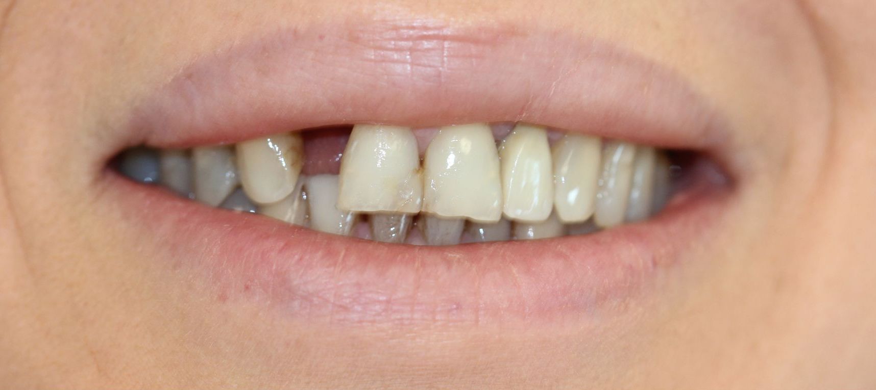 Prima e dopo 4 - Arte Dentale Frosinone