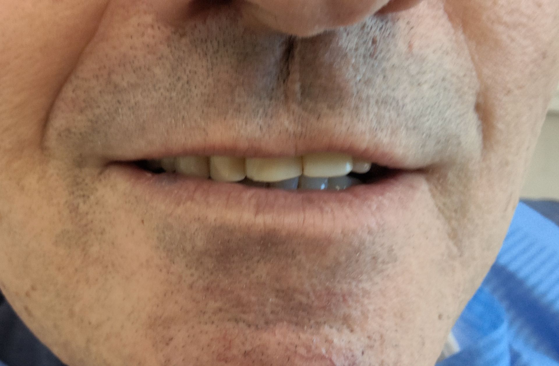Prima e dopo 6 - Arte Dentale Frosinone