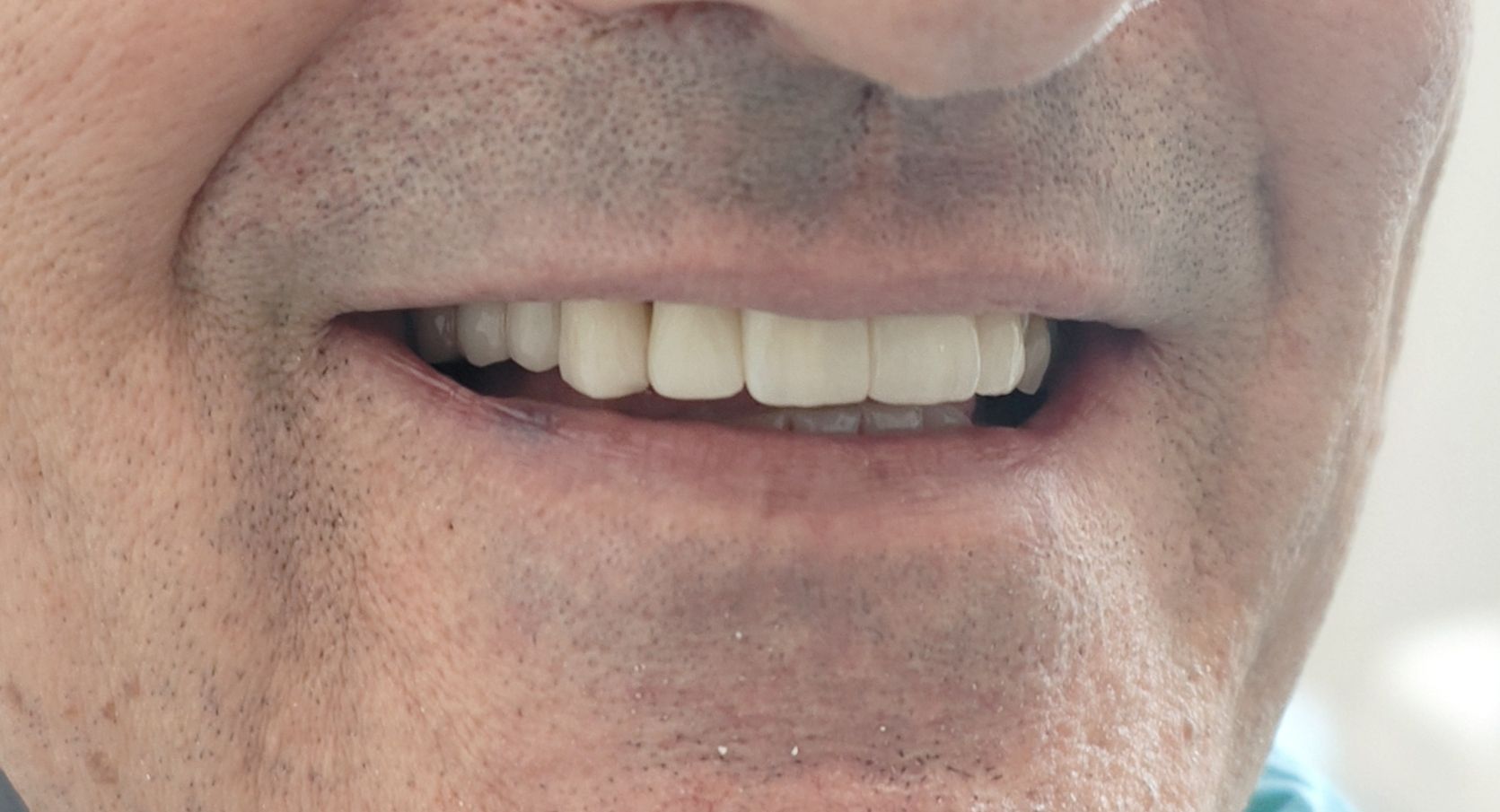 Prima e dopo 7 - Arte Dentale Frosinone