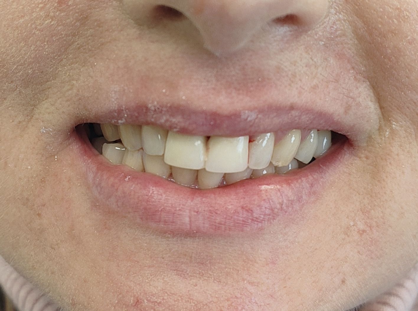 Prima e dopo 8 - Arte Dentale Frosinone