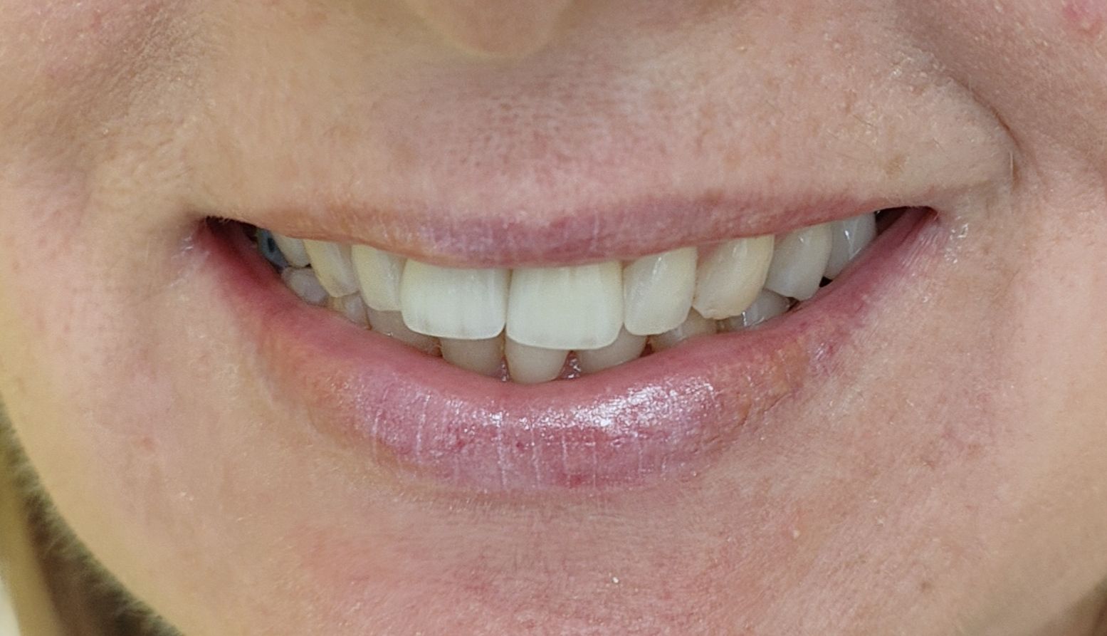 Prima e dopo 9 - Arte Dentale Frosinone