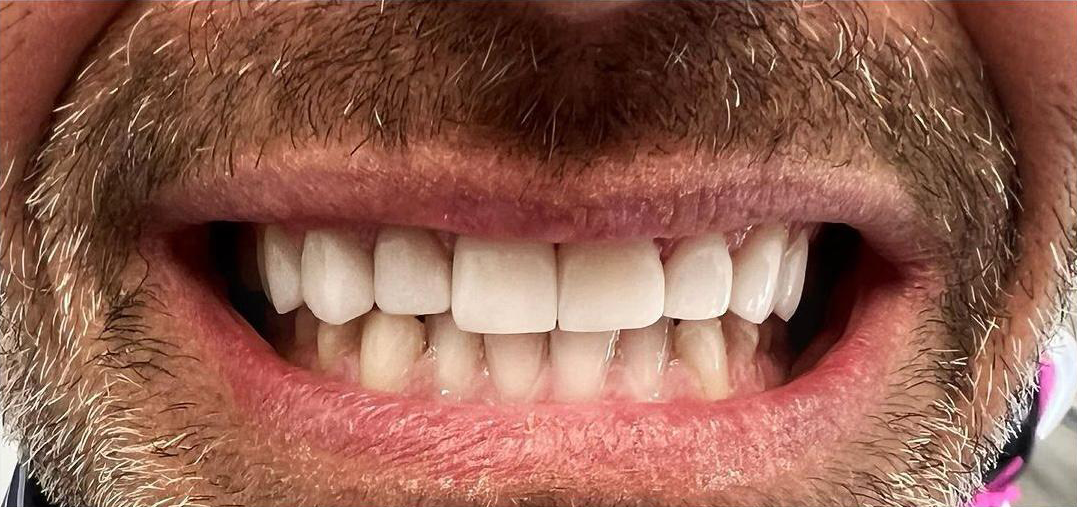 Prima e dopo 13 - Arte Dentale Frosinone