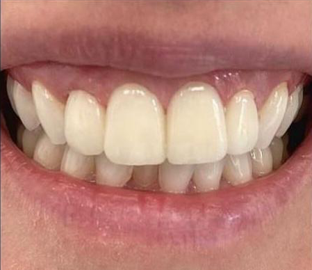 Prima e dopo 15 - Arte Dentale Frosinone