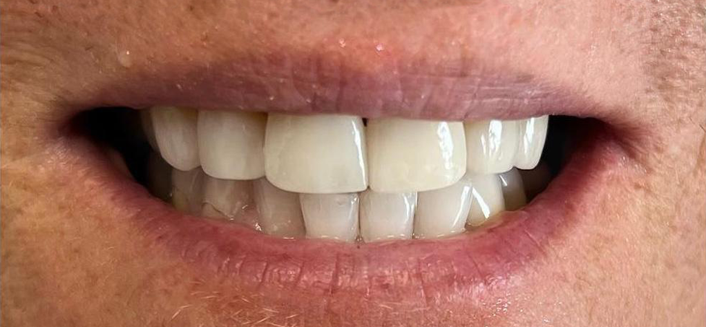 Prima e dopo 17 - Arte Dentale Frosinone