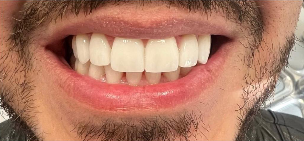 Prima e dopo 19 - Arte Dentale Frosinone