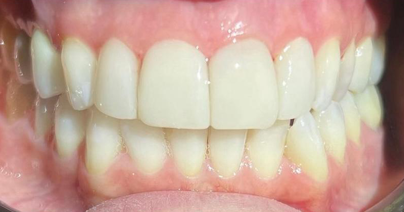 Prima e dopo 11 - Arte Dentale Frosinone