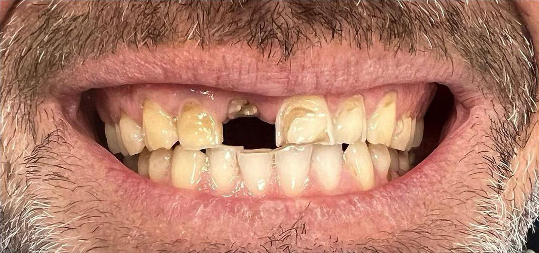 Prima e dopo 12 - Arte Dentale Frosinone