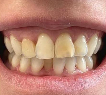 Prima e dopo 14 - Arte Dentale Frosinone