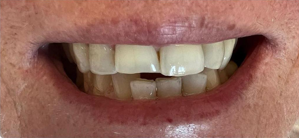 Prima e dopo 16 - Arte Dentale Frosinone