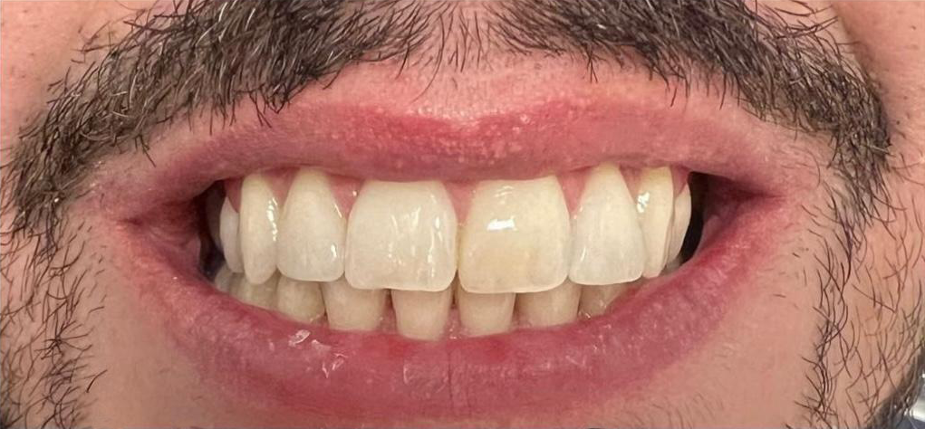 Prima e dopo 18 - Arte Dentale Frosinone