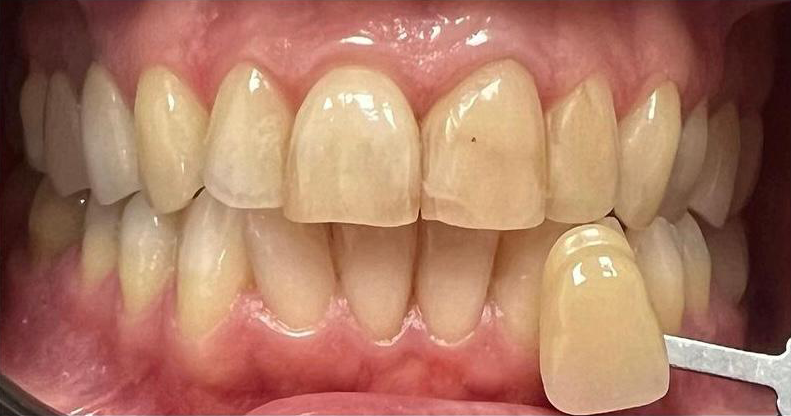 Prima e dopo 10- Arte Dentale Frosinone