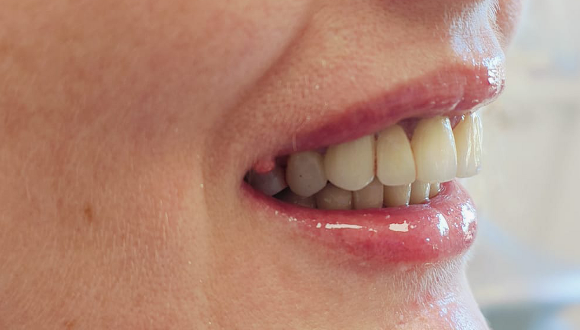 Prima e dopo 24 - Arte Dentale Frosinone