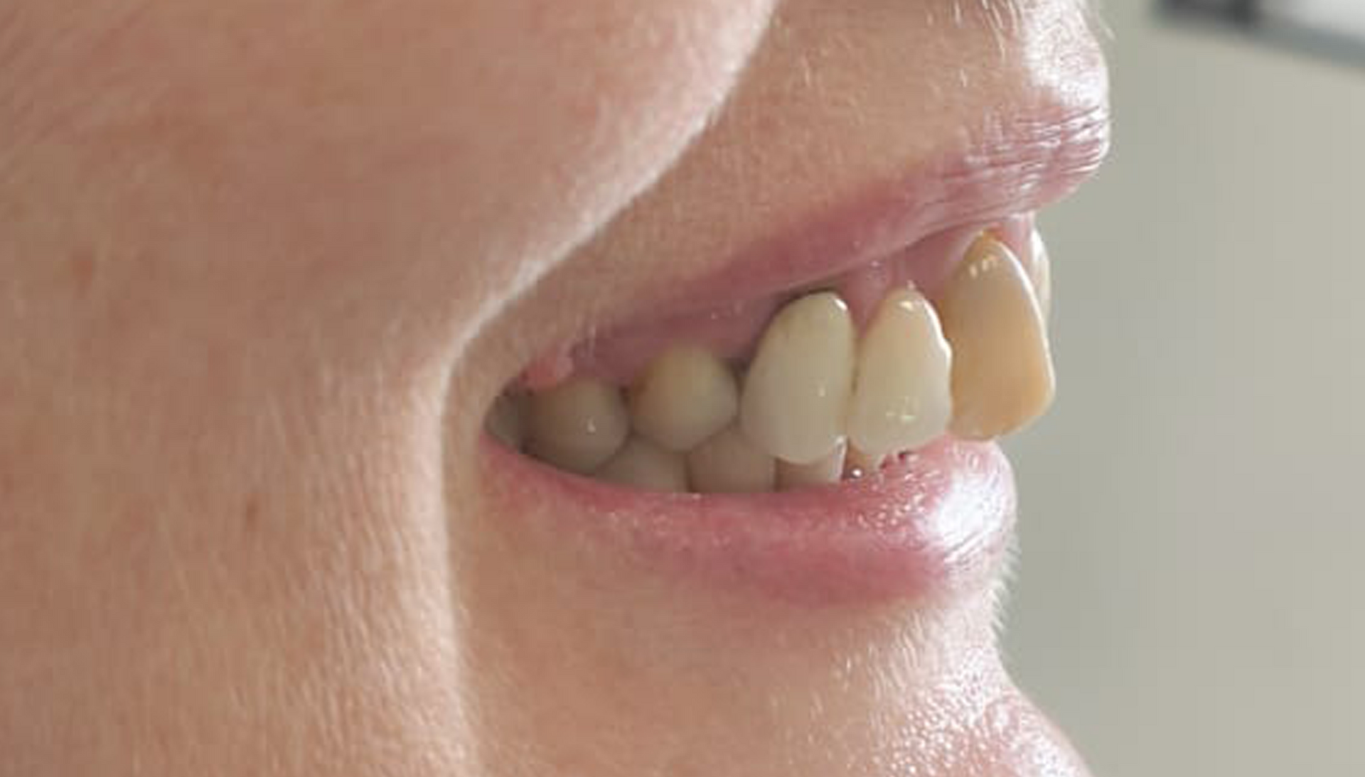 Prima e dopo 22 - Arte Dentale Frosinone 
