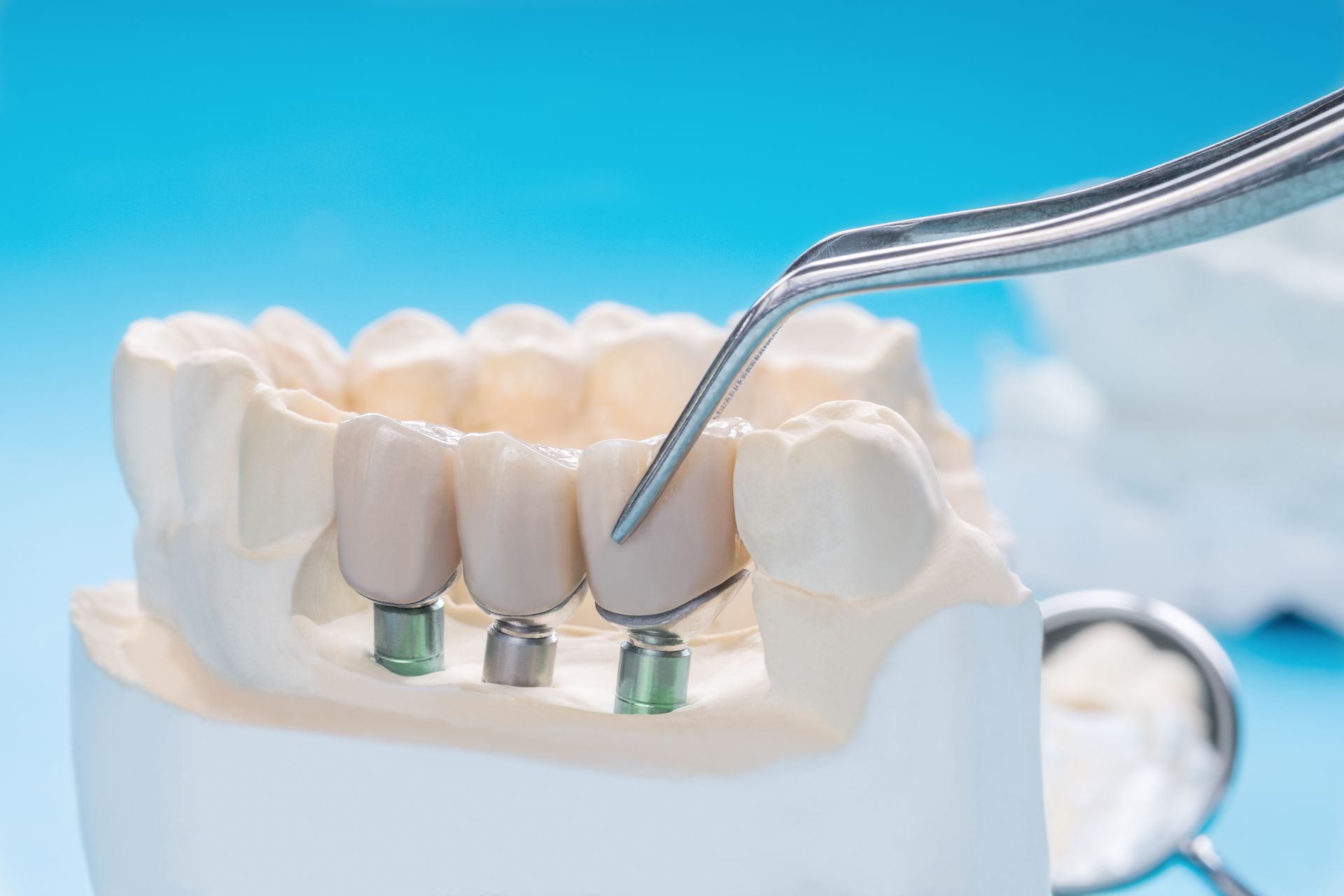 Un modello di ponte dentale viene appoggiato sugli impianti - Arte Dentale Frosinone