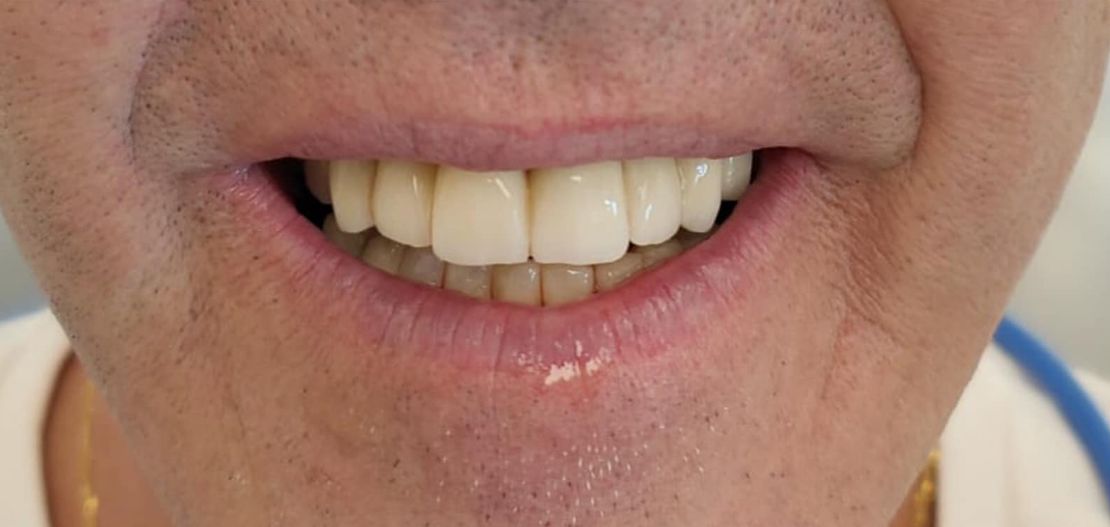 Prima e dopo 3 - Arte Dentale Frosinone
