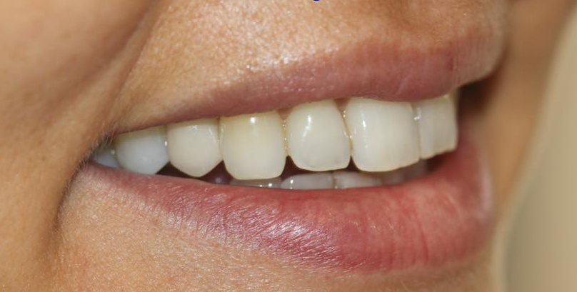 Prima e dopo 1 - Arte Dentale Frosinone