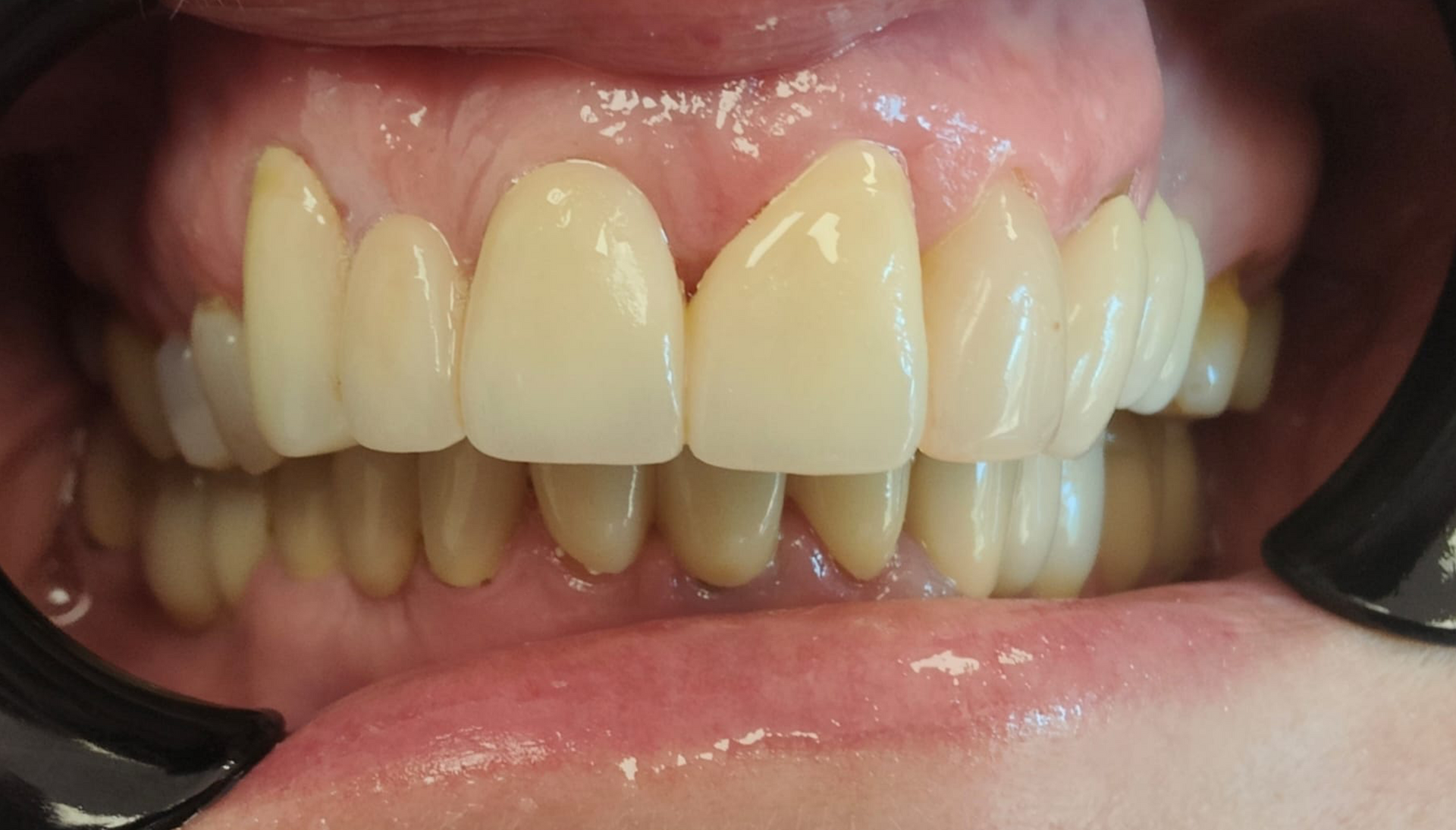 Prima e dopo 21 - Arte Dentale Frosinone