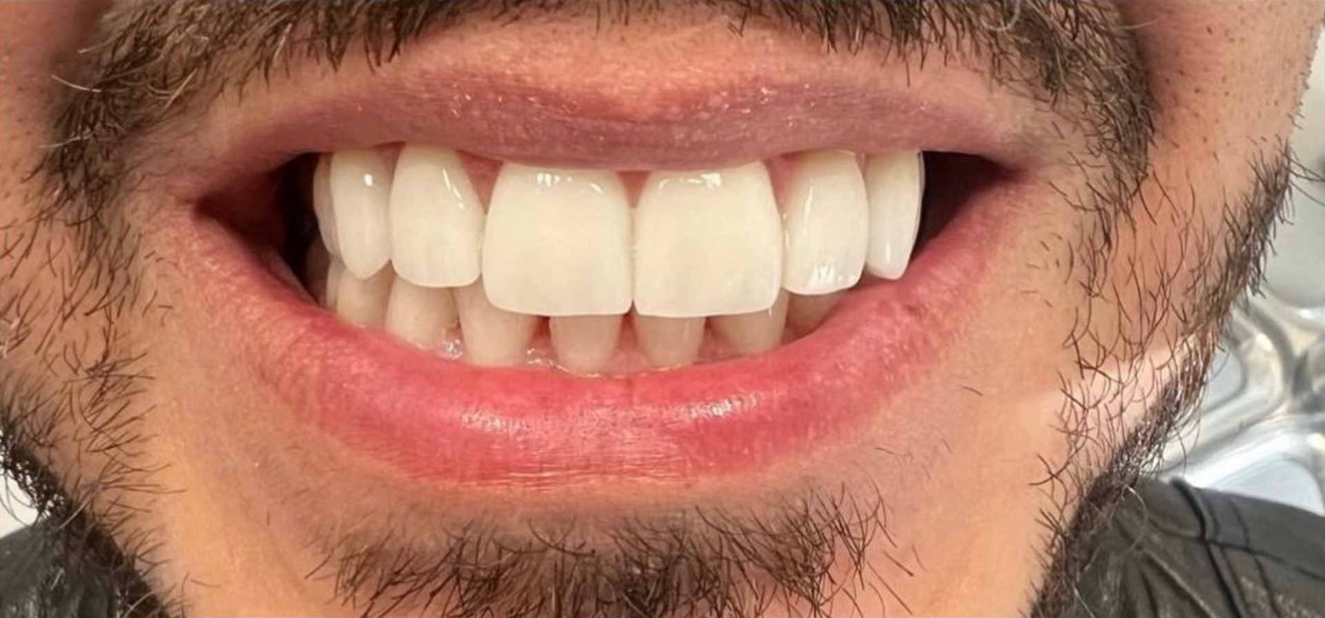 Un primo piano della bocca con denti perfetti grazie alle faccette  1 - Arte Dentale Frosinone