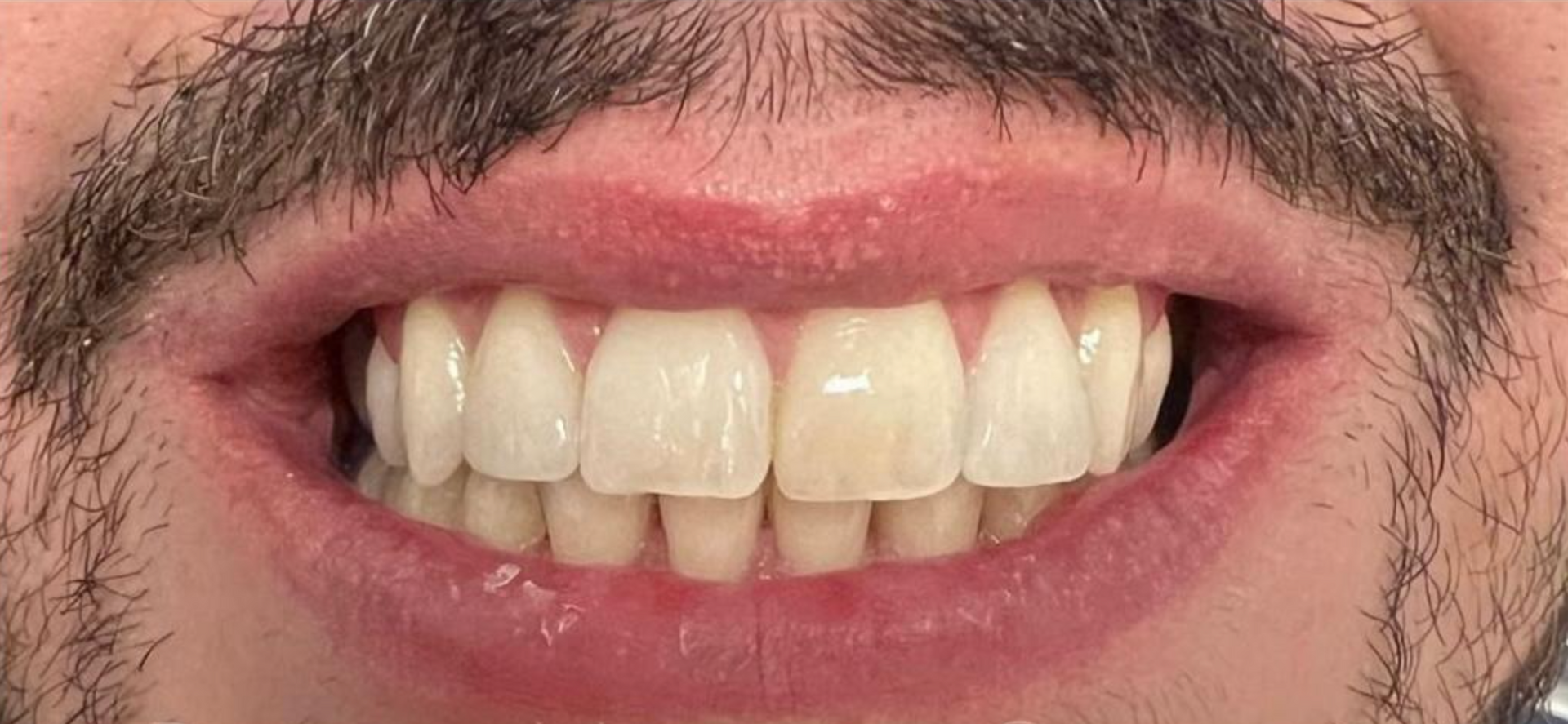 Un primo piano della bocca di un uomo con barba e denti rovinati 1 - Arte Dentale Frosinone