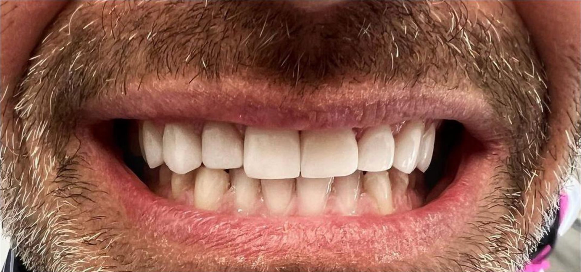 Un primo piano della bocca con denti perfetti grazie alle faccette  1 - Arte Dentale Frosinone