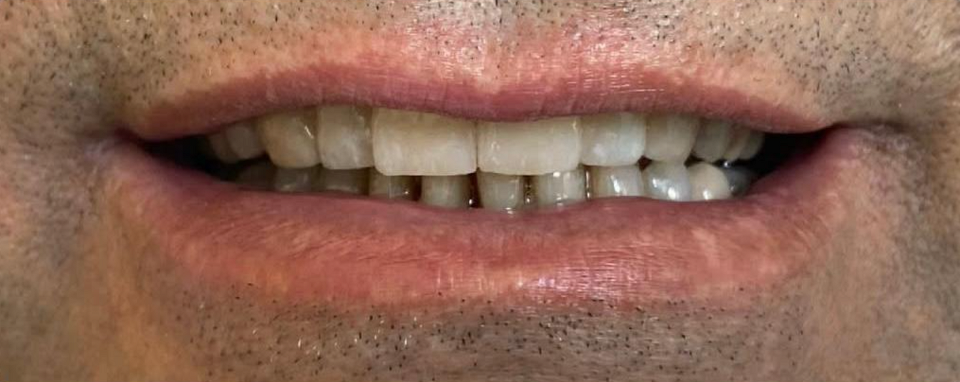 Un primo piano della bocca con denti perfetti grazie alle faccette  1 - Arte Dentale Frosinone