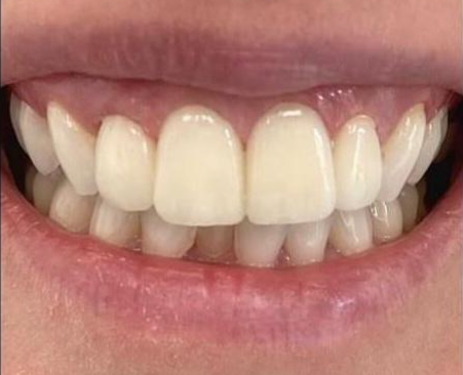 Un primo piano della bocca con denti perfetti grazie alle faccette  1 - Arte Dentale Frosinone