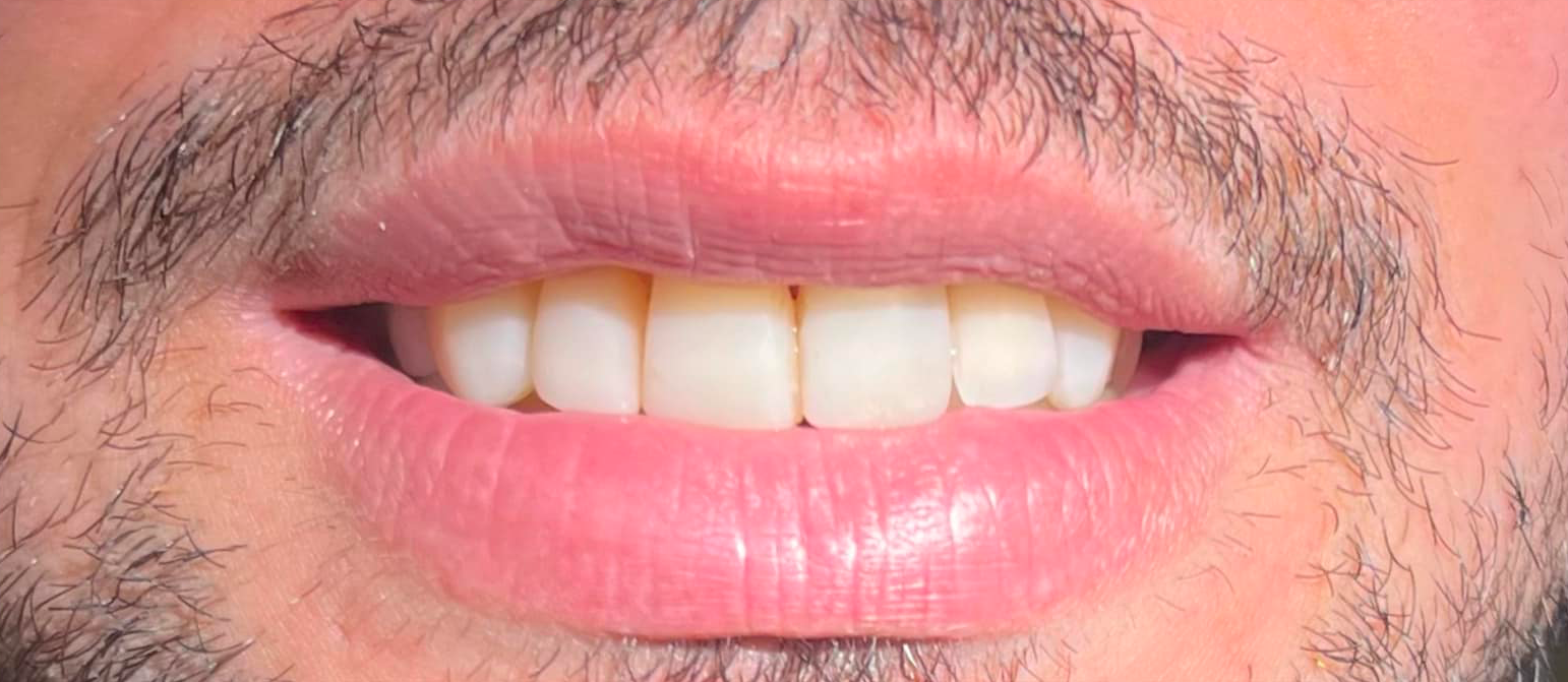Un primo piano della bocca di un uomo con barba e denti perfetti grazie alle faccette - Arte Dentale Frosinone