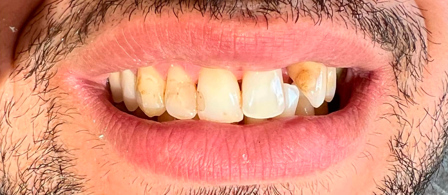 Un primo piano della bocca di un uomo con la barba e i denti rovinati - Arte Dentale Frosinone