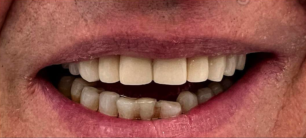 Parodontite prima dopo 1 - Arte Dentale Frosinone