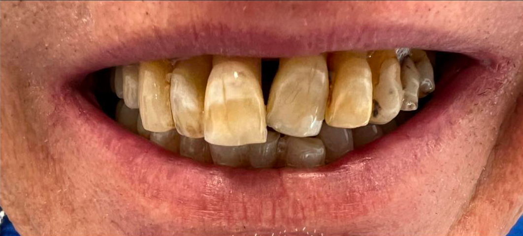 Parodontite prima dopo - Arte Dentale Frosinone