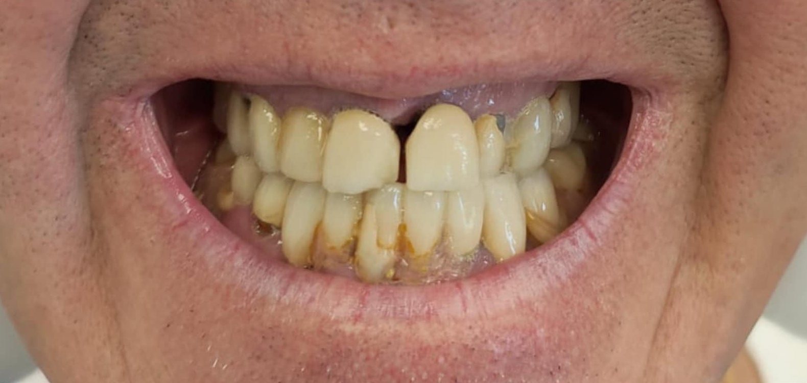 Prima e dopo 2 - Arte Dentale Frosinone