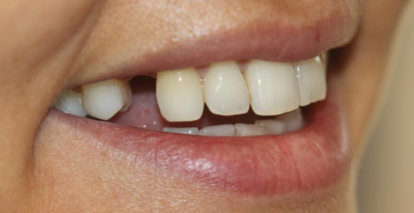 Prima e dopo - Arte Dentale Frosinone