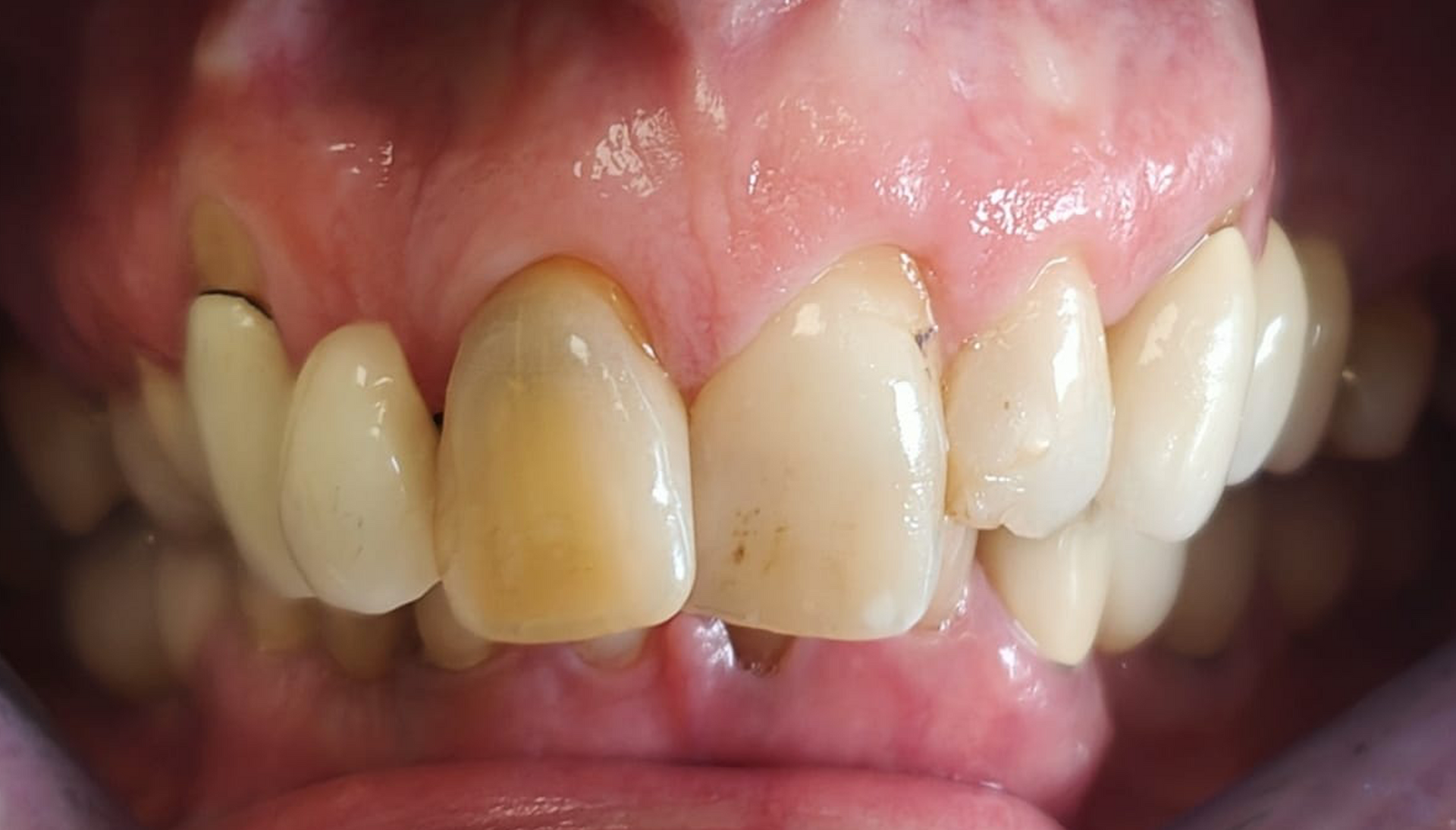 Prima e dopo 20 - Arte Dentale Frosinone