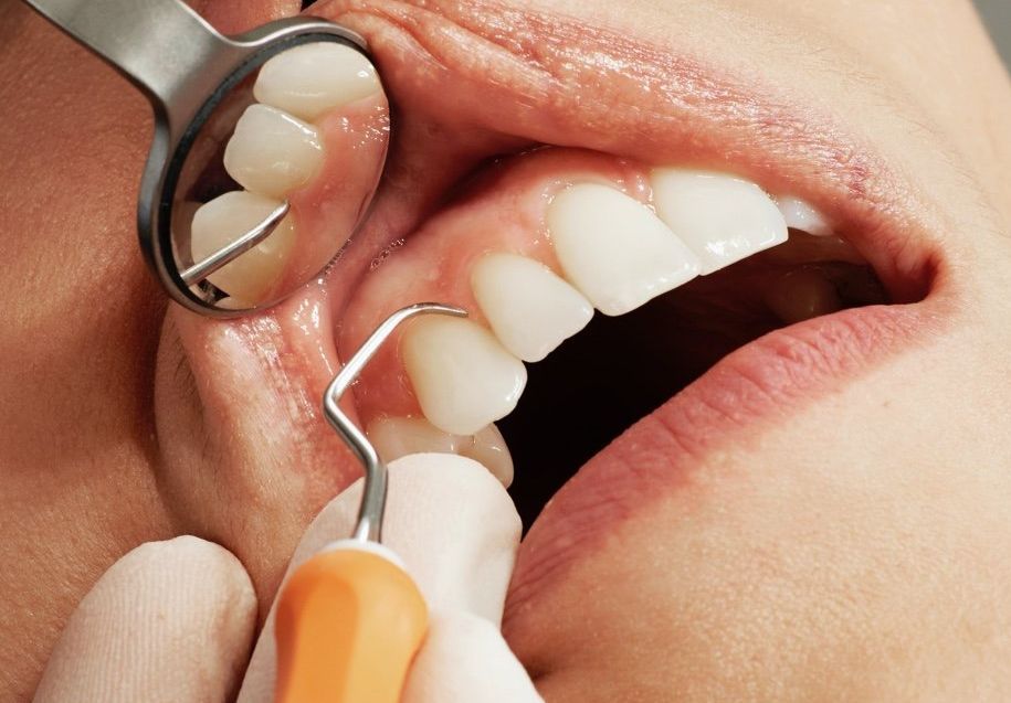 Trattamenti curativi 4- Arte Dentale Frosinone