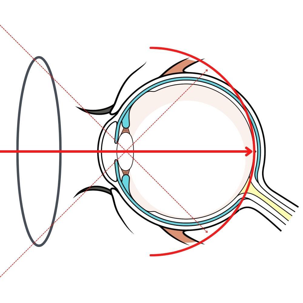 Ein Diagramm eines menschlichen Auges mit einem roten Pfeil, der auf die Linse zeigt.