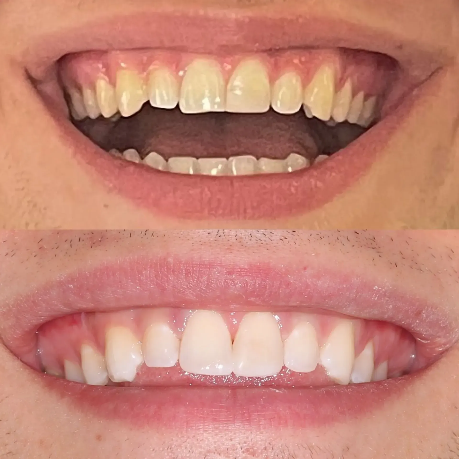 Close-up of two smiling mouths, one with yellowed upper teeth and one with white teeth