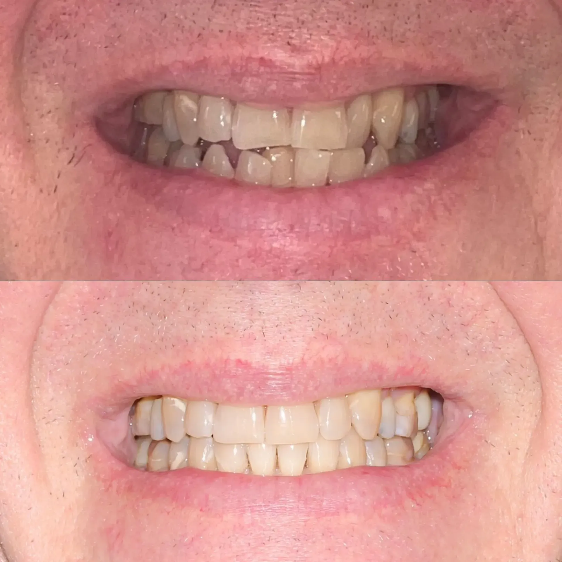 Close-up of a mouth showing upper and lower teeth with a gap between the front teeth
