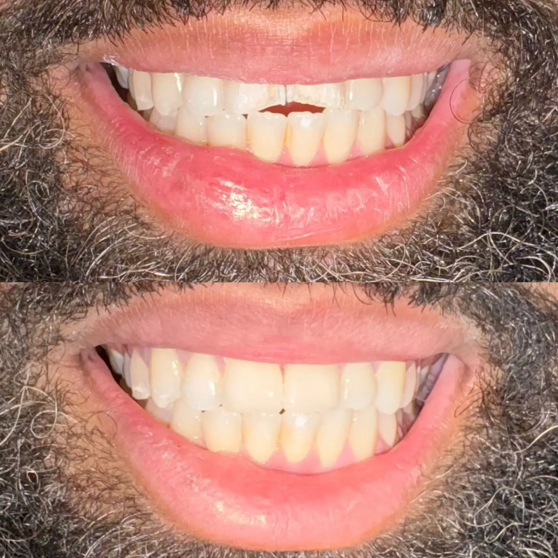 Two smiling mouths showing teeth, one with yellowed upper front tooth and one more evenly white.