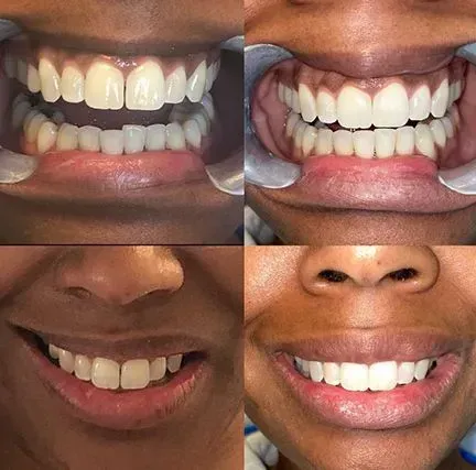 Four close-up smiles showing teeth before-and-after whitening and alignment changes