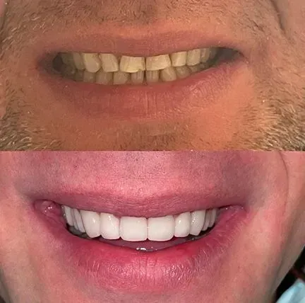 Close-up of a mouth showing before-and-after teeth whitening, yellowed teeth above and bright white teeth below