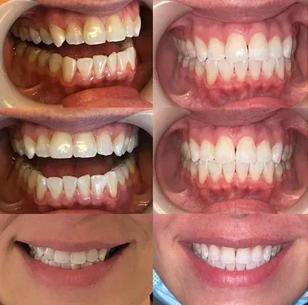 Before-and-after collage of teeth and smiles, showing dental alignment improvement.