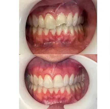 Two close-up photos of teeth and gums, showing a before-and-after view of red, inflamed gums improving.