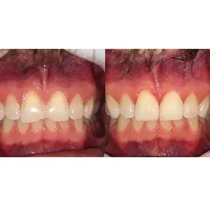 Close-up before-and-after of teeth alignment, showing front teeth with one tooth shifted outward.