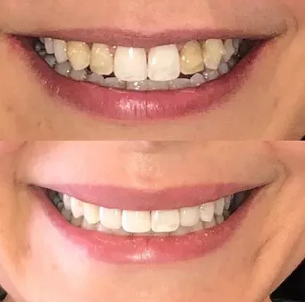 Side-by-side close-up of a smiling mouth before and after teeth whitening